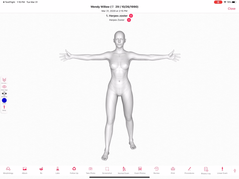 Dermatome.gif